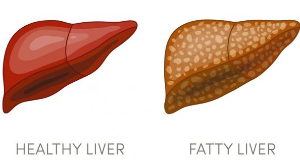 What Supplements Get Rid of Fatty Liver.png